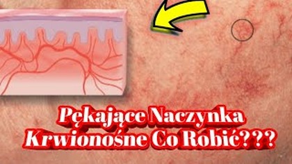 1916.  Pękające Naczynka Krwionośne???